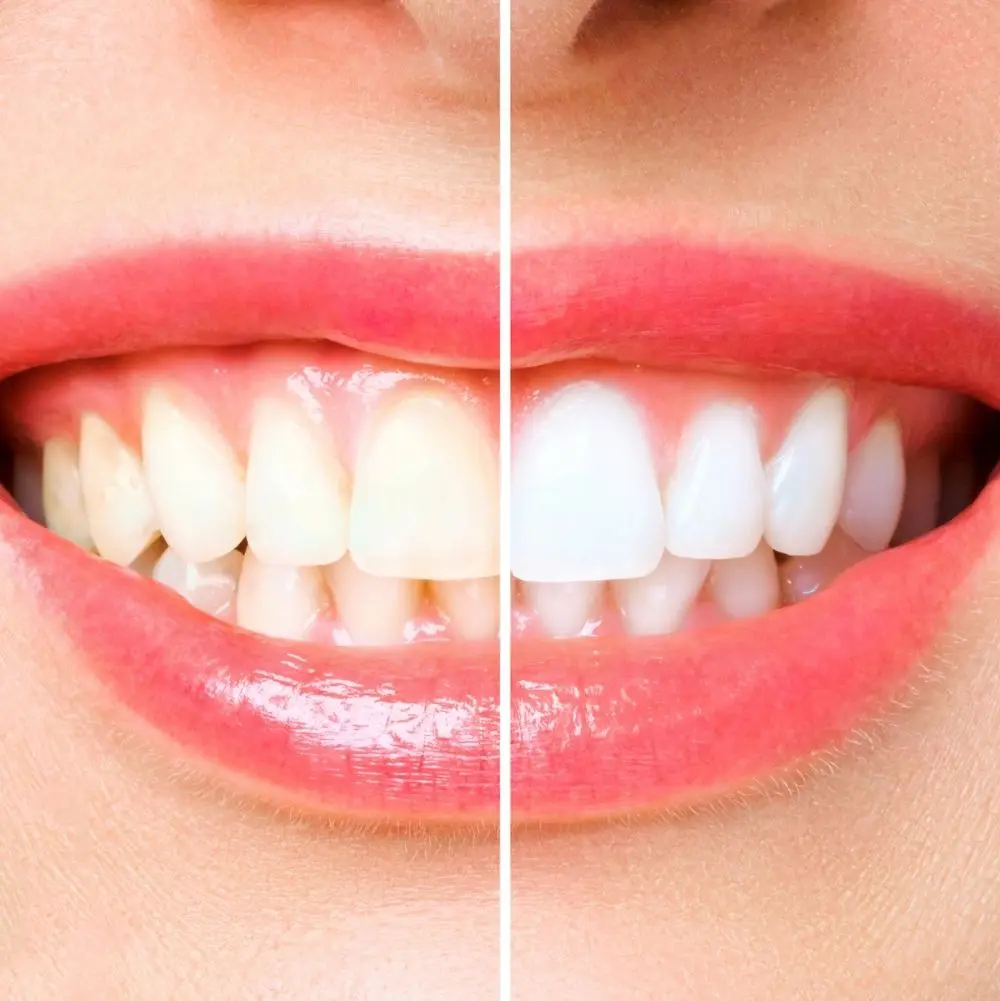 Essential Tips for Dental Health: Your Guide to a Healthier Smile